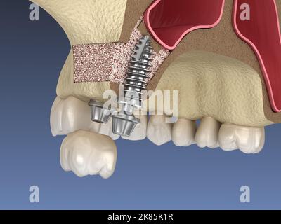 Sinus Lift Surgery - implant installation. 3D illustration Stock Photo