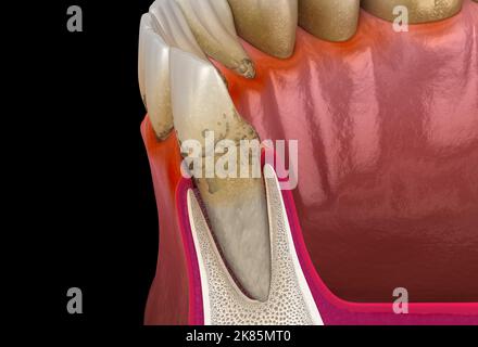 Periodontitis stage 2, gum recession, tartar. Medically accurate 3D illustration Stock Photo