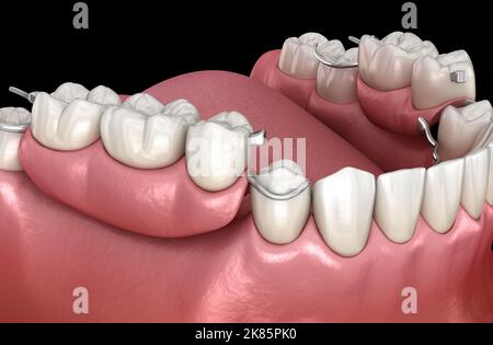 Removable partial denture, mandibular prosthesis. Medically accurate 3D ...