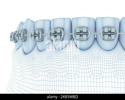 Braces and denture. Wire 3d model illustration Stock Photo