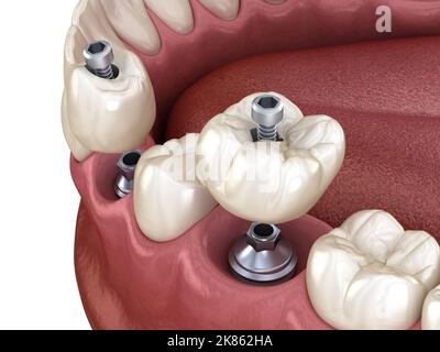 Premolar and Molar tooth crown installation over implant, screw fixation. 3D illustration of dental treatment Stock Photo