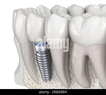 Premolar tooth recovery with implant. Medically accurate 3D illustration of human teeth and dentures concept Stock Photo