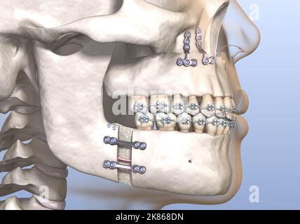 Maxillomandibular Advancement surgery. Medically accurate dental 3D illustration. Stock Photo