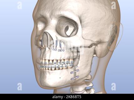 Maxillomandibular Advancement surgery. Medically accurate dental 3D illustration. Stock Photo