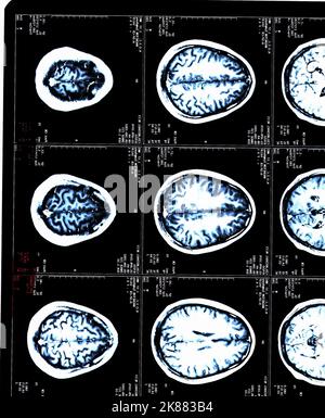 A MRI brain scans of a patient with Multiple Sclerosis Stock Photo - Alamy
