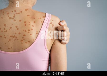 Scratching Itchy Skin. Sensitive Eczema Rash And Dermatitis Stock Photo