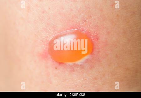 Dermatology and skin conditions: blister on skin of an Asian woman due to a skin infection or allergic reaction Stock Photo