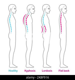 Vector Medical illustration of the Spine, diagram of the human spinal ...