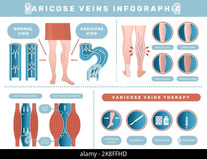 Varicose infographic. Venous disease medical health problems with human blood venous recent vector template set Stock Vector