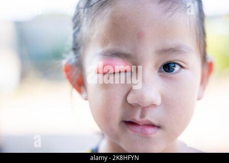 Stye Eye diseases. Closed Asian kid little girl eye with sty, eyelid abscess ophthalmic hordeolum Stock Photo