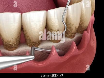 Open Curettage: Scaling And Root Planing (conventional Periodontal ...