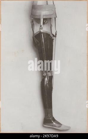 Photography from 'An account of manufacturing at the State Railway's prosthetic workshop in Nässjö', 1932. Bone prosthesis for male patient. Stock Photo