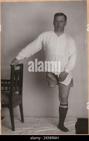 Photography from 'An account of manufacturing at the State Railway's prosthetic workshop in Nässjö', 1932. Man with femoral battle. Stock Photo