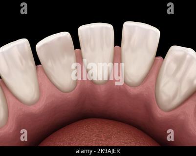 Excessive Spacing between teeth. Dental 3D illustration concept Stock ...