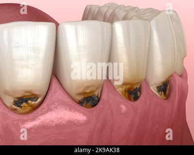 Cervical caries on frontal teeth. Medically accurate tooth 3D ...