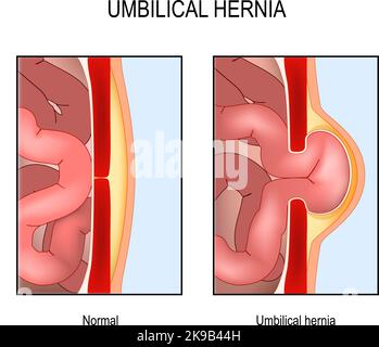 Umbilical hernia. Cross section of abdomen with small intestine, muscle and abdominal wall. Normal human's belly and muscle rupture with hernial sac. Stock Vector