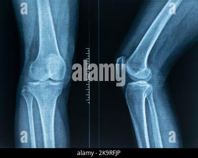 radiography of a young male arm humerus on top Stock Photo