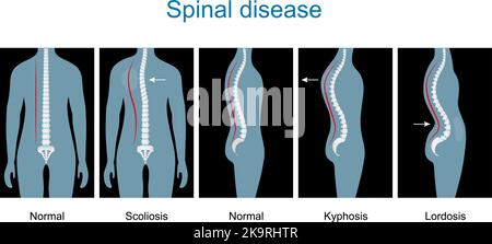 Spinal disease. types of spine defects. Human Skeleton and bones. Vertebral column disorders. Normal spine and Spinal deformity from Scoliosis Stock Vector