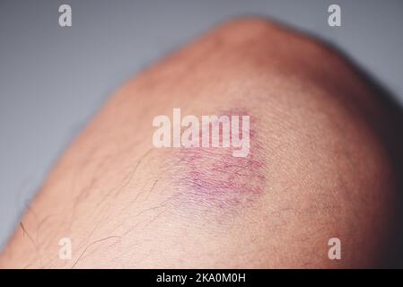 bruised on knee - wound bruised on  leg caused by sports and bump or fall, leg injury Stock Photo