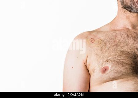 shoulder arthroscopy surgical metal staple suture. traumatologist patient mid caucasic man  Stock Photo