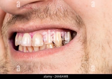 Plaque on human teeth is colored pink with indicator tablets. Stock Photo