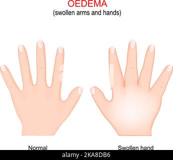 Edema. Swollen arms and hands. oedema is the build-up of fluid in the body's tissue. Vector illustration. Poster for medical use Stock Vector