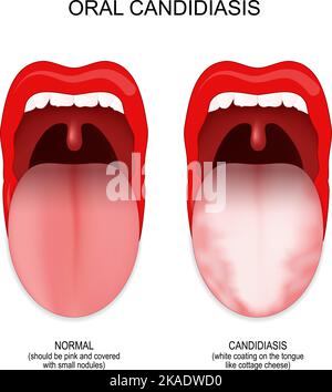 oral candidiasis. oral thrush yeast infection. White coating on the ...