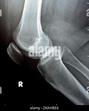 plain x ray on knee joint showing joint space narrowing and Subchondral ...