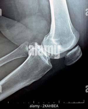 plain x ray on knee joint showing joint space narrowing and Subchondral Sclerosis on medial compartment (thickening of bone that happens in joints aff Stock Photo
