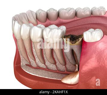Periostitis tooth - Lump on Gum Above Tooth. Medically accurate dental ...