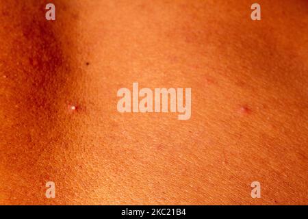 human skin texture. wart and pimples on skin micro photo. close up photo. Stock Photo