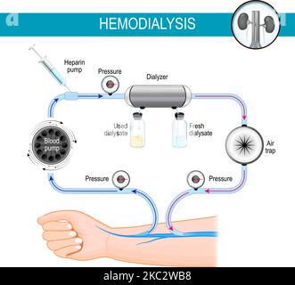 The principle of Hemodialysis machine. Dialysis process. haemodialysis is diverting blood into an external machine, where it's filtered Stock Vector