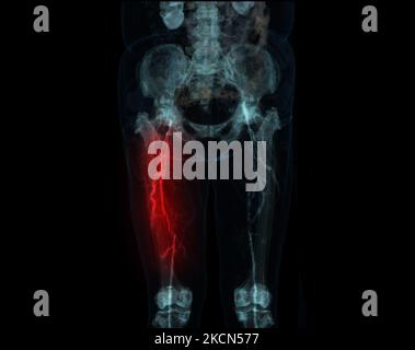 CT scan of lower extremity  ,3D illustration of Femur bone , knee joint , leg and foot . Stock Photo