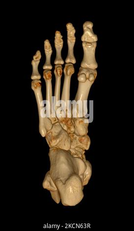 3D rendering  of the foot bones for diagnosis bone fracture and rheumatoid arthritis from CT scannner. Stock Photo