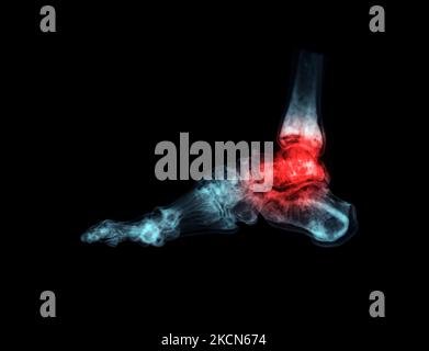 3D rendering  of the foot bones for diagnosis bone fracture and rheumatoid arthritis from CT scannner. Stock Photo