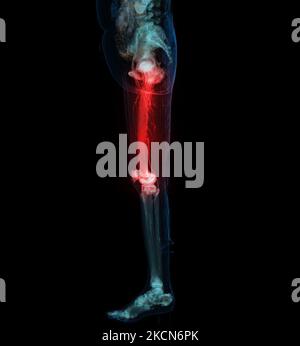 CT scan of lower extremity  ,3D illustration of Femur bone , knee joint , leg and foot . Stock Photo