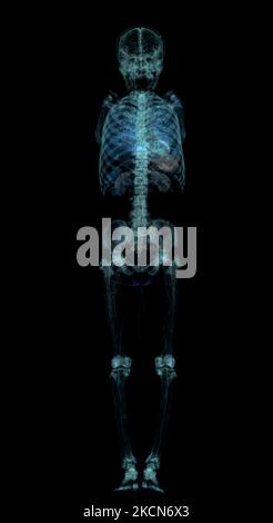 CT Scan ankle and foot or Computed Tomography of Ankle joint and Foot ...