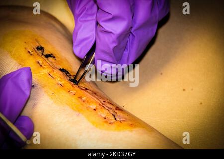 Doctor with purple gloves  removing stiitches in a leg  with tweesers - close-up selective focus Stock Photo