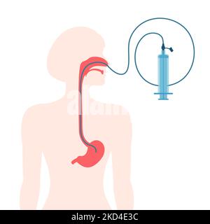 Nasogastric tube, illustration Stock Photo