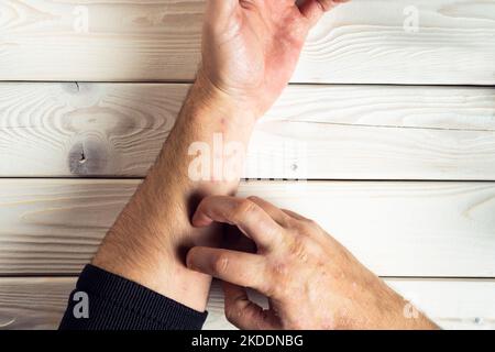 Top view of unrecognizable man suffering from psoriasis, scratching red, inflamed, flaky rash on skin of arm with fingers on white wooden background. Stock Photo