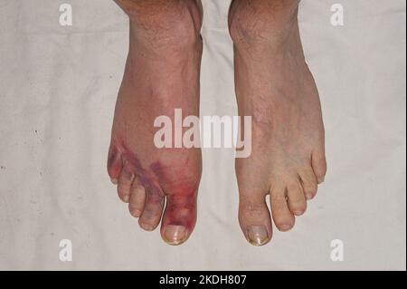 Injured and swollen toes on a man's right foot compared to an uninjured left. Stock Photo