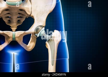 Hip prosthesis or implant isolated on blue background with copy space. Hip joint or femoral head replacement 3D rendering illustration. Medicine, medi Stock Photo