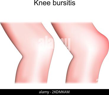 Knee bursitis. Prepatellar bursitis. difference and comparison of healthy joint and inflammation knee. Lateral or side view of human leg. Vector Stock Vector