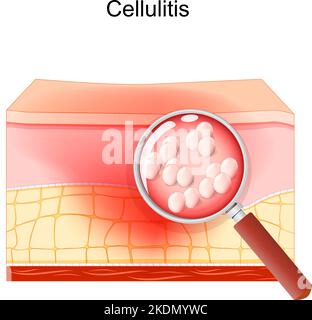 cellulitis. Cross section of layers of the human Skin with symptoms of ...