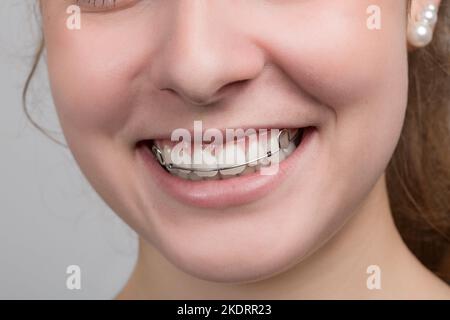 young girl is smiling and shows her removable dental brace Stock Photo
