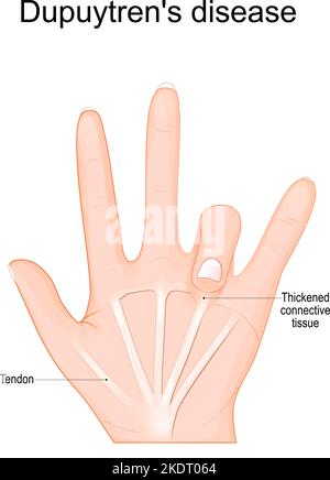 Dupuytren's disease. Human hand with Tendons and Thickened connective tissue under one finger. Vector illustration Stock Vector