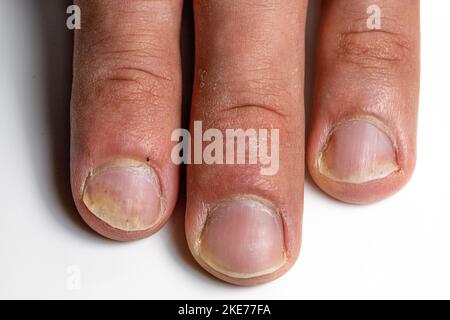 Eczema on Nails, What It Looks Like, and How It's Diagnosed and Treated