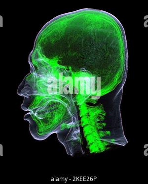 Head and neck, CT scan Stock Photo