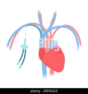 Tunneled central line venous catheter medical diagram Stock Vector