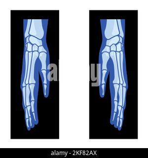 Human palm xray. Hand bones anatomy illustration Stock Vector Image ...